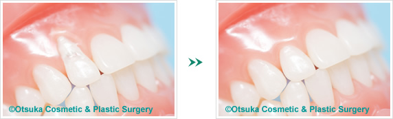 歯ぐきの移植・形成