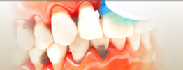 歯ぐきの再生治療・歯周病