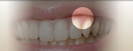 歯ぐきの移植・形成・整形