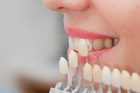 step2 オフィスホワイトニング　希望の歯の白さを確認