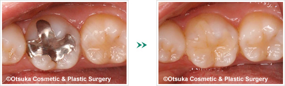 銀歯を白い詰め物へ