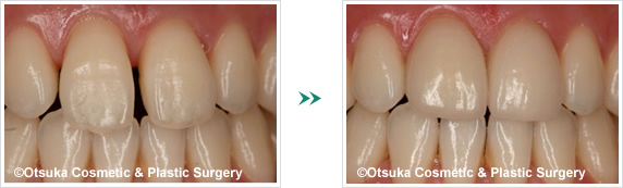 前歯の拡大