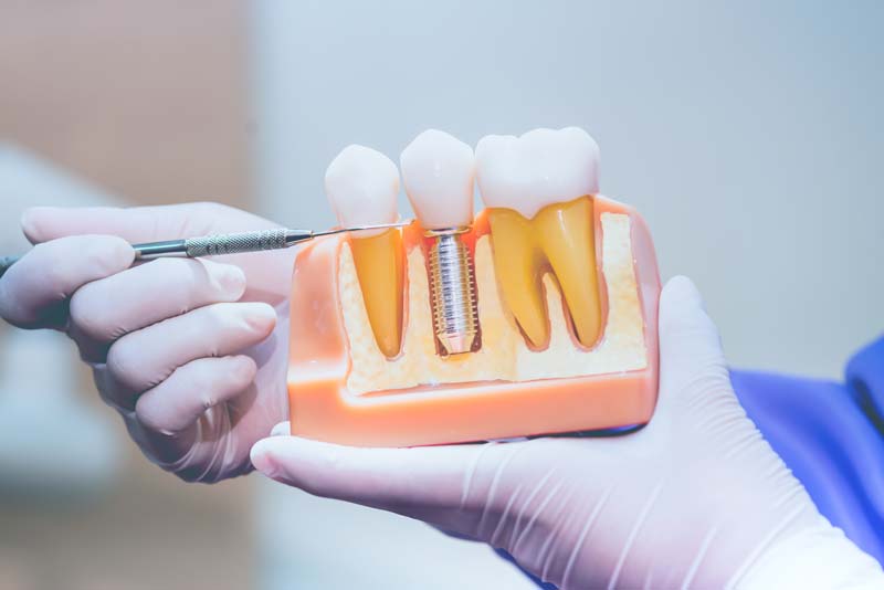 歯科治療説明イメージ