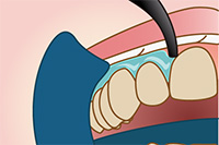 step3 オフィスホワイトニング　歯茎に保護材を塗布