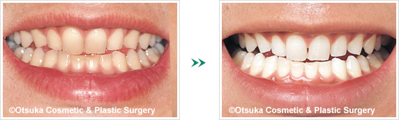 歯のホワイトニングの症例写真